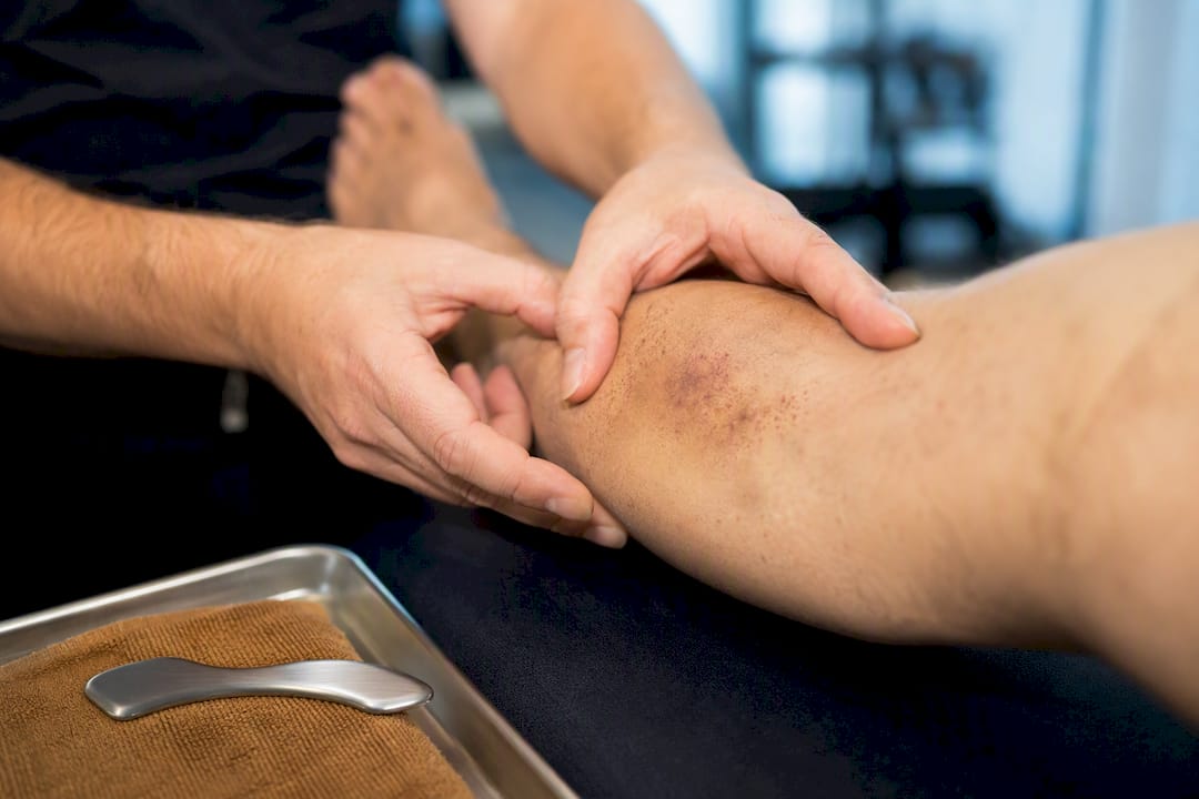 3–14 Days After Graston Technique: Clinic Signs of Normal Bruising